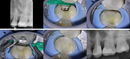 Deep Margin Elevation (DME) in Endodontic Restorative Cases: Why the DME Wedge Is Ideal