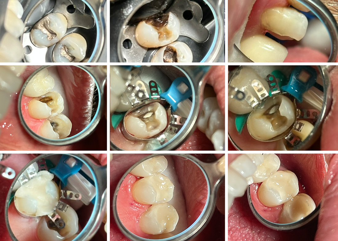 Subgingival Restoration on an Upper Premolar Using the Rhondium QuickConnect Matrix and DME Wedge